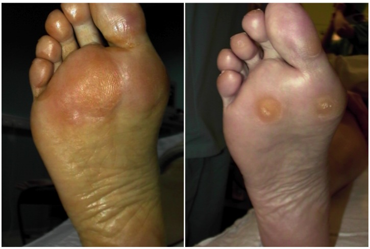 Metatarsalgia – Foot and Ankle Institute