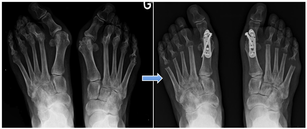 Вальгусная деформация стопы рентген фото